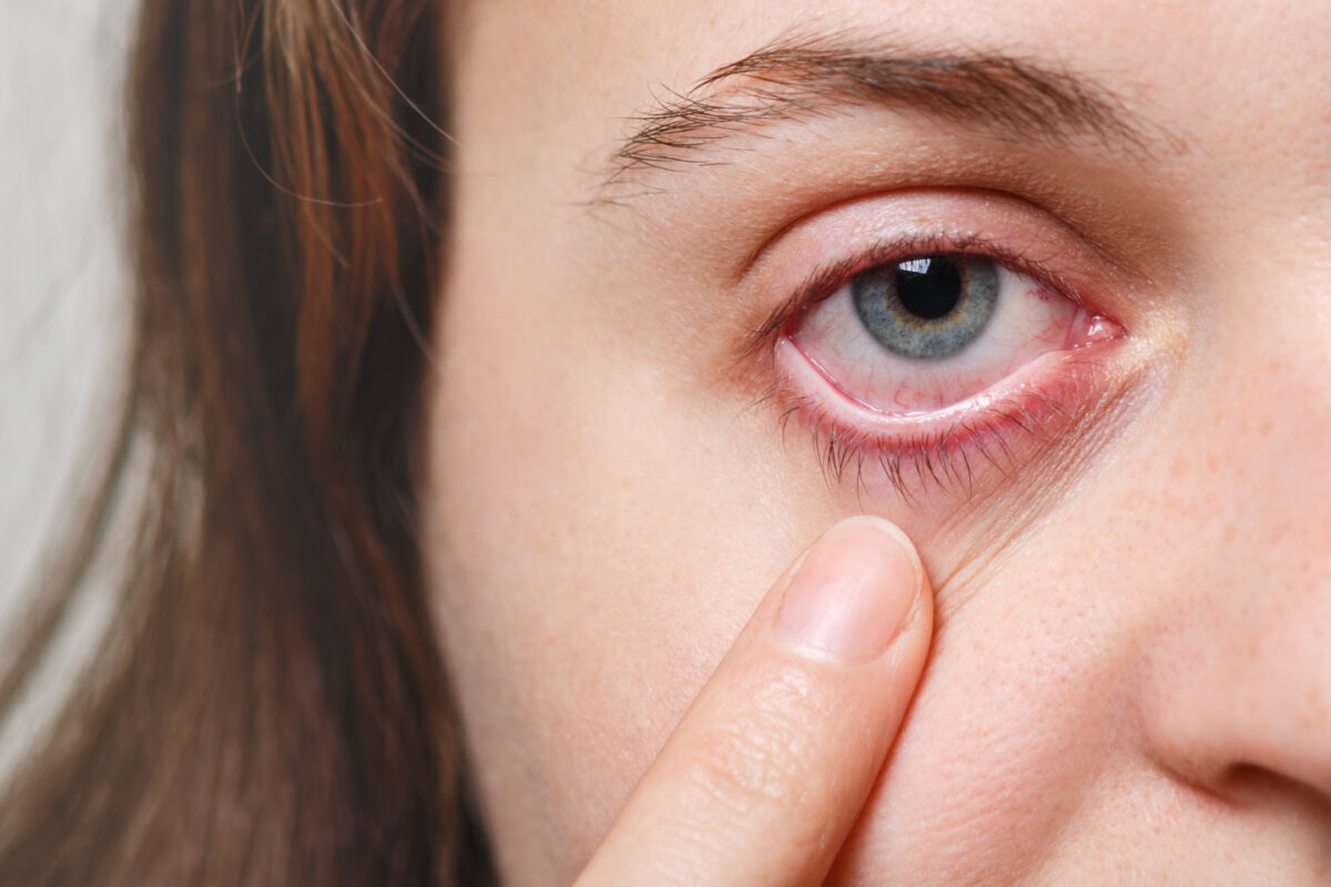 جفاف العين:أسبابه وعلاجه، يُعد جفاف العيون أمرًا شائعًا يُعاني منه العديد من الأشخاص في جميع أنحاء العالم.