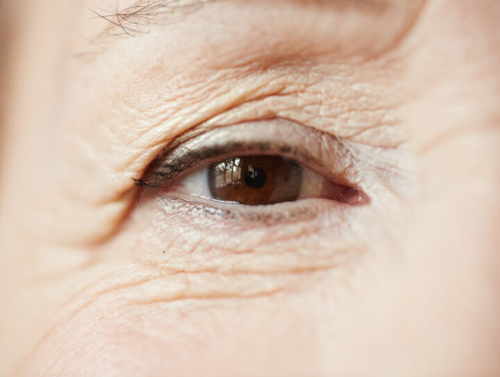 تجاعيد العين تعتبر مشكلة شائعة تواجه الكثير من النساء. فإن العين هي منطقة حساسة جدا في الوجه وتتعرض دائما لتجاعيد وخطوط رفيعة بسبب عوامل مثل التقدم في السن وتعرض الجلد للشمس والتوتر والإرهاق.