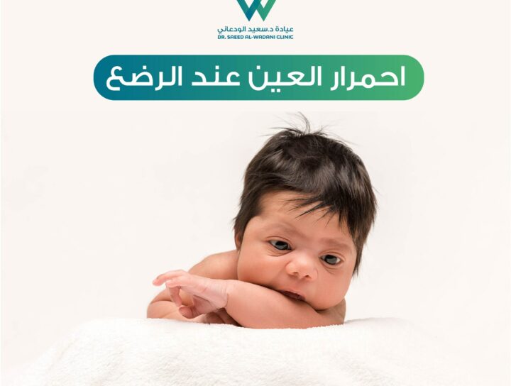 احمرار العين عند الرضع، يُعد احمرار العين من أكثر الأعراض شيوعًا لدى الرضع، مما قد يثير قلق الوالدين.