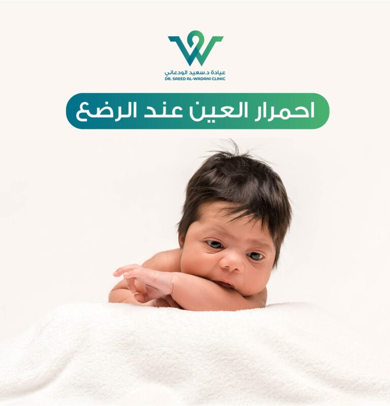 احمرار العين عند الرضع، يُعد احمرار العين من أكثر الأعراض شيوعًا لدى الرضع، مما قد يثير قلق الوالدين.