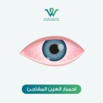 احمرار العين المفاجئ يعد حالة شائعة قد تواجه الكثيرين في مختلف المراحل العمرية.