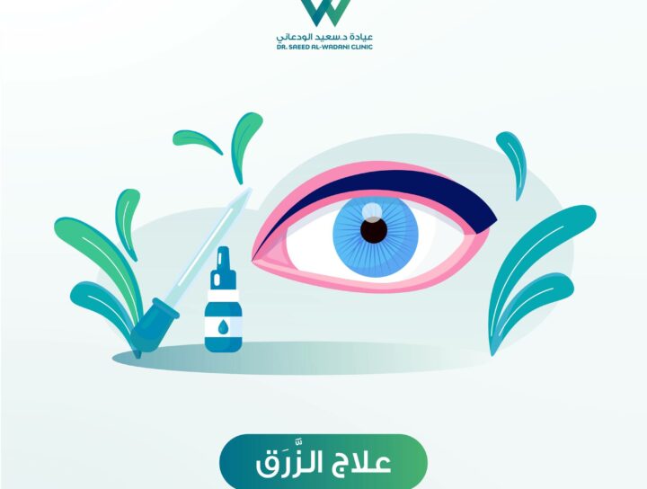 علاج الزرق والحفاظ على البصر هو موضوع حيوي لأي شخص يعاني من هذا المرض الخطير الذي يمكن أن يؤدي إلى فقدان البصر إذا لم يُعالج بشكل صحيح. الزرق، المعروف أيضًا باسم الجلوكوما، هو حالة تسبب تلف العصب البصري نتيجة زيادة الضغط داخل العين.