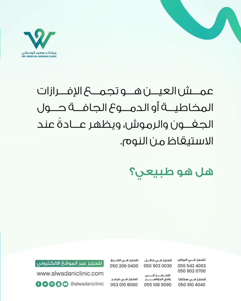 يُعرف عمش العين بأنه تجمع إفرازات مخاطية أو دمعية جافة حول الجفون والرموش، ويظهر عادة عند الاستيقاظ من النوم. هذه الإفرازات تتكوّن نتيجة عمل طبيعي يقوم به الجسم لتنظيف العين من الغبار، الخلايا الميتة، والجراثيم. وغالبًا ما تكون بلون شفاف مائل للبياض، أو صفراء خفيفة.