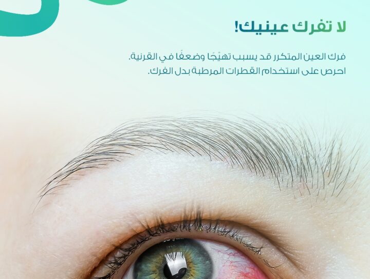 عين تعاني من الاحمرار بسبب جفاف العين مع توعية باستخدام القطرات المرطبة للحفاظ على صحة العين